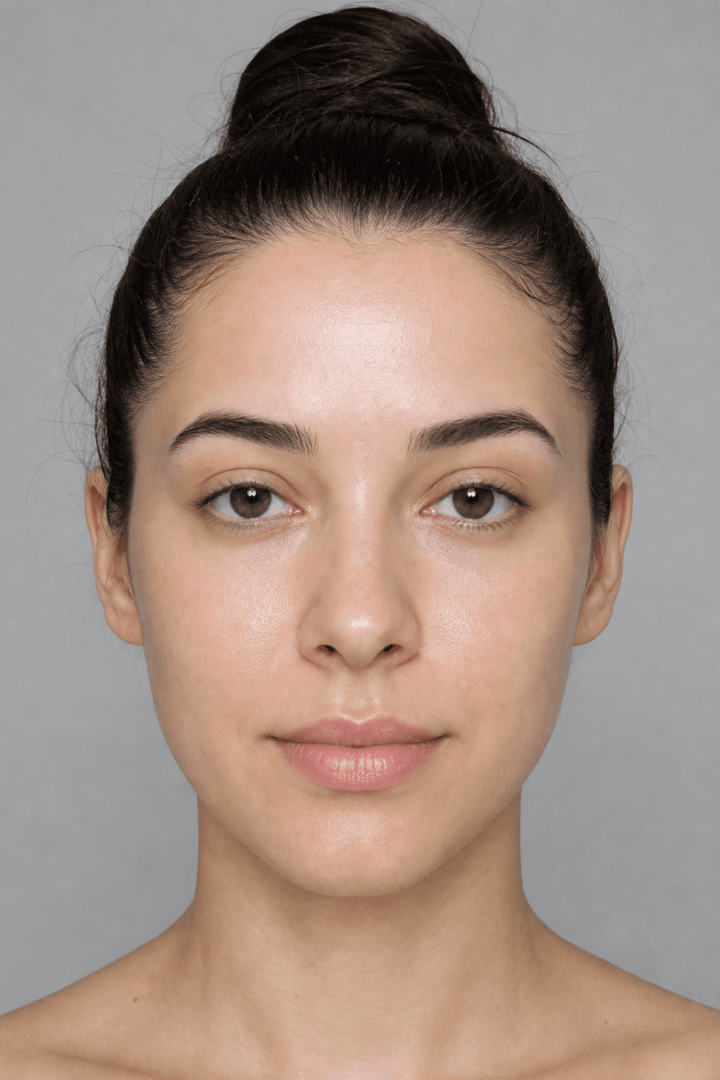 After microneedling treatment — illustrative example