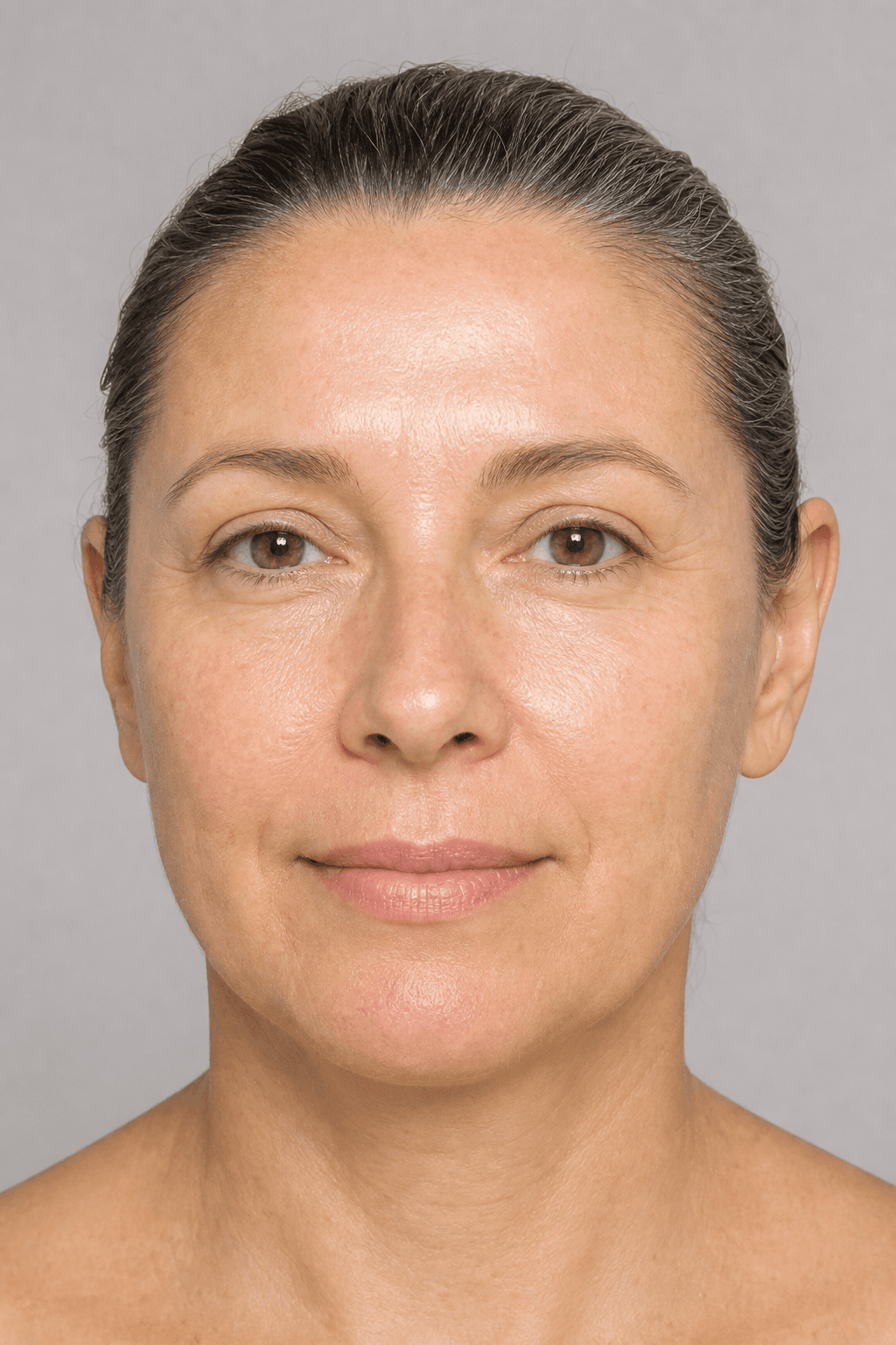 After microneedling treatment — illustrative example