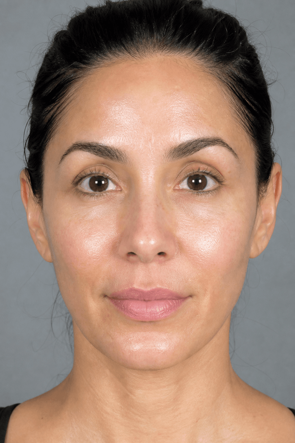 After Vampire Facial treatment — illustrative example