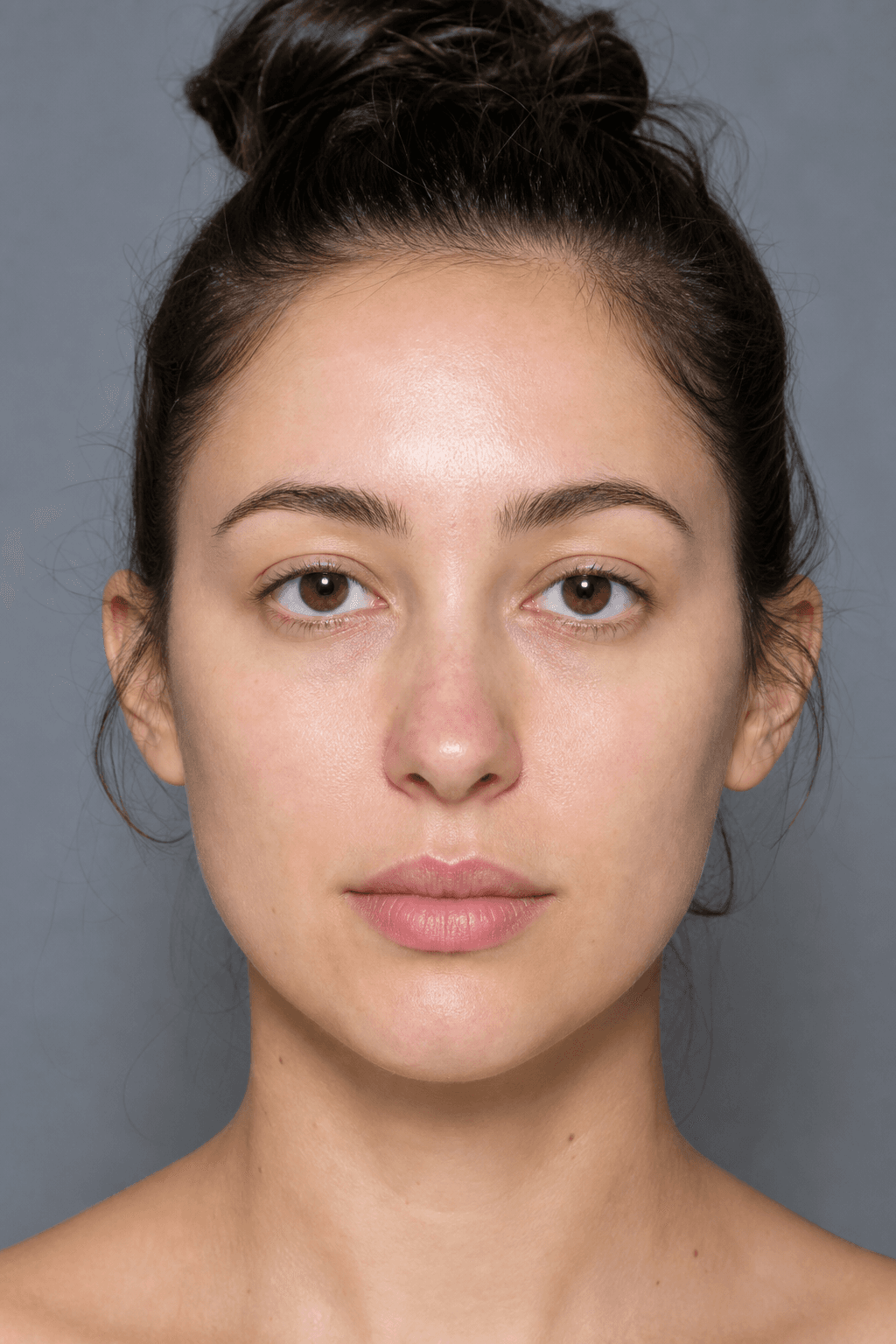After Vampire Facial treatment — illustrative example