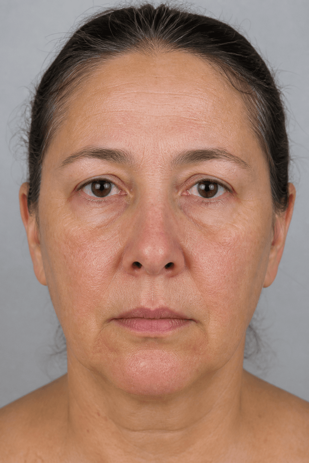 Before microneedling treatment — illustrative example