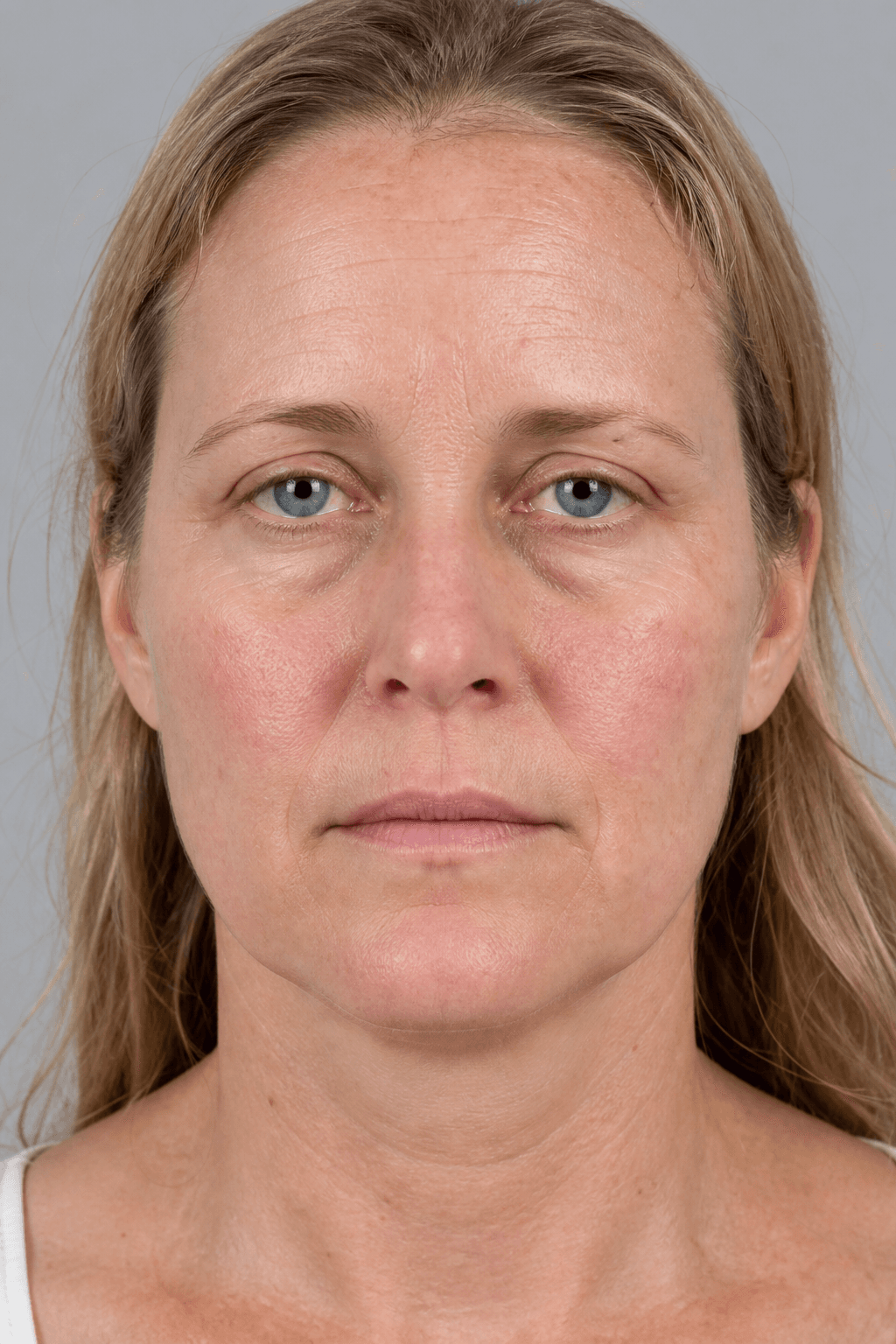 Before Vampire Facial treatment — illustrative example